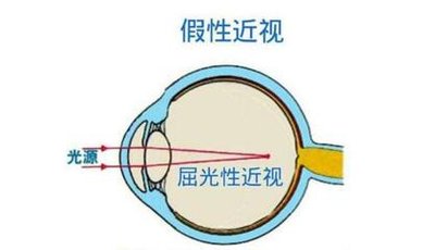 眼睛是如何一步步发展成“高度近视”的？这些原因可能被你忽视了！