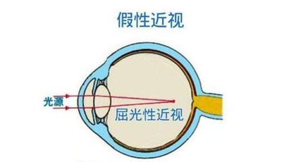 眼睛是如何一步步发展成“高度近视”的？这些原因可能被你忽视了！